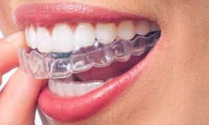 ORTODONZIA INVISIBILE